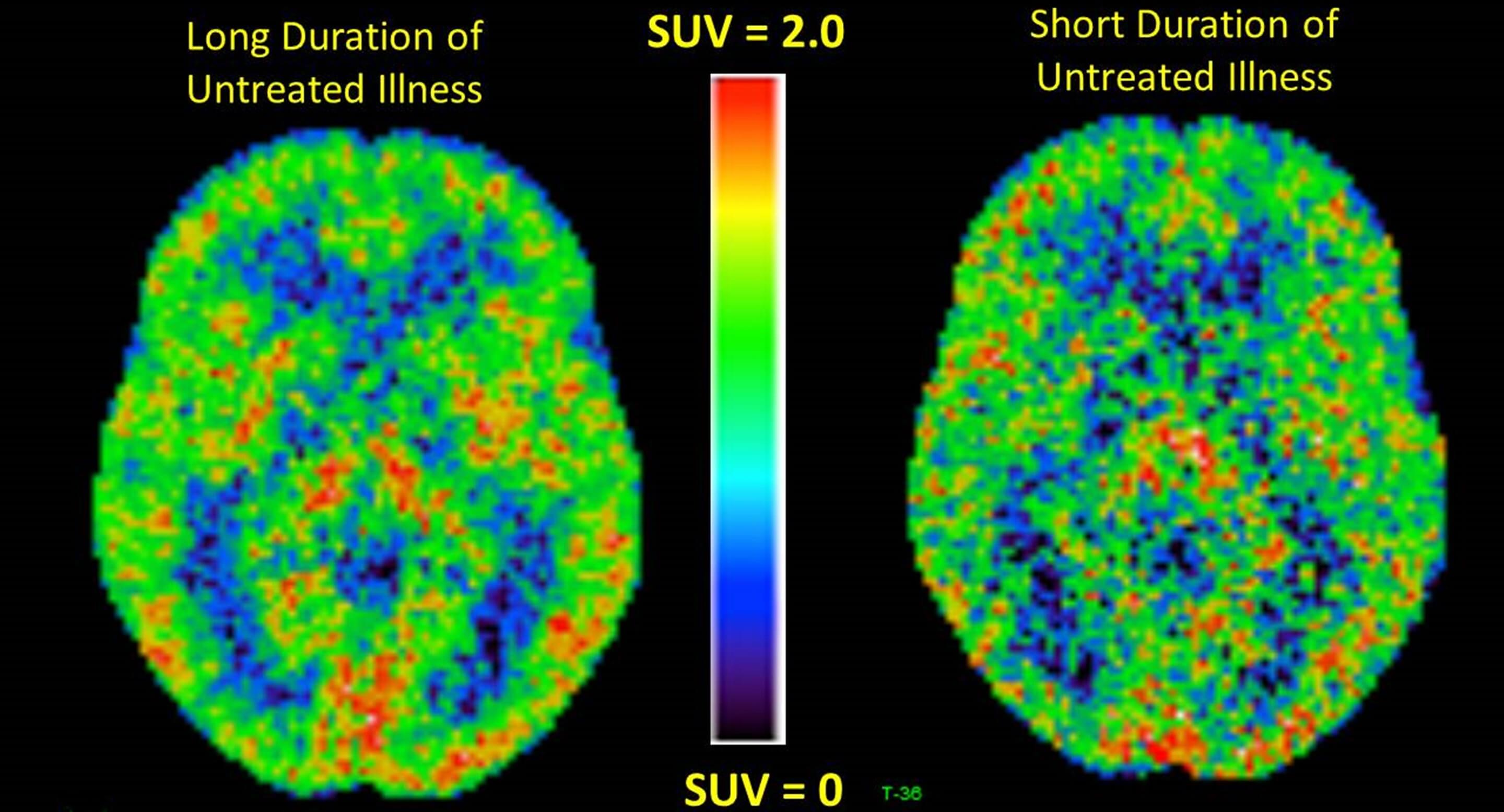 Positron emission tomography (PET) brain scans in people with long or short durations of depression