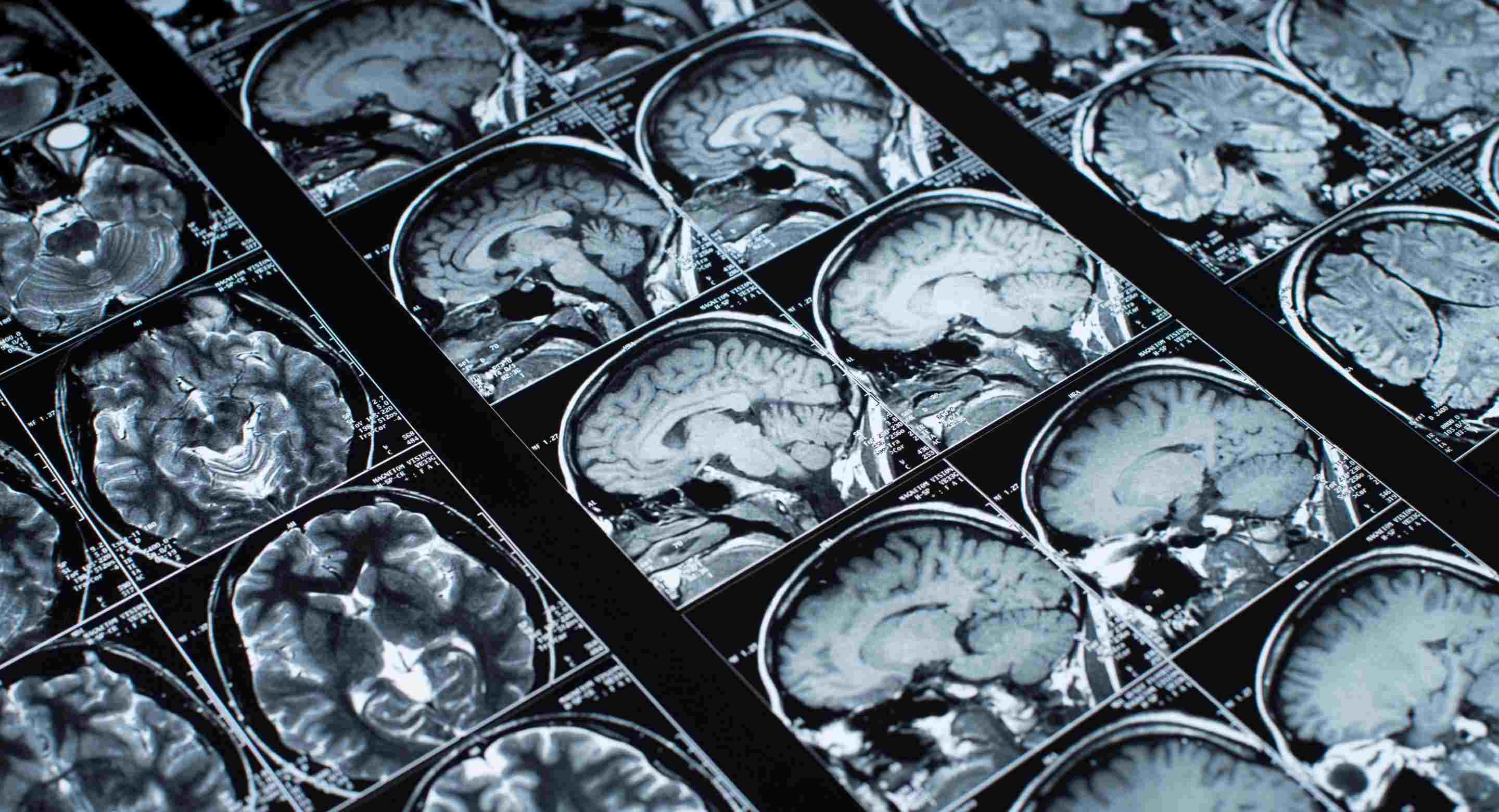 Brain Imaging Scans